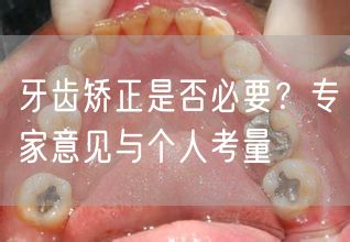 牙齿矫正是否必要？专家意见与个人考量