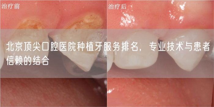 北京顶尖口腔医院种植牙服务排名，专业技术与患者信赖的结合
