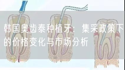 韩国奥齿泰种植牙：集采政策下的价格变化与市场分析(图1)