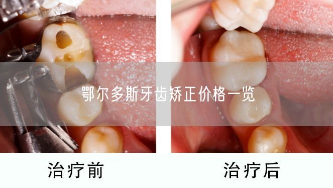 鄂尔多斯牙齿矫正价格一览(图1)