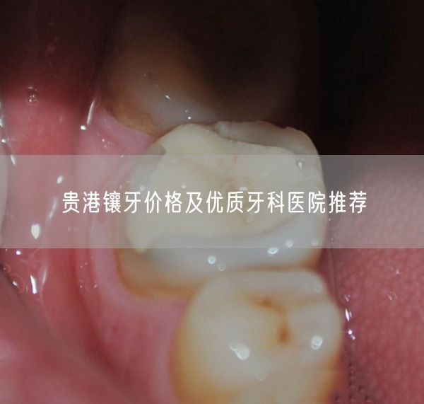 贵港镶牙价格及优质牙科医院推荐(图1)
