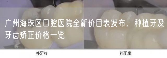广州海珠区口腔医院全新价目表发布，种植牙及牙齿矫正价格一览(图1)