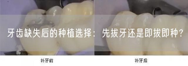 牙齿缺失后的种植选择：先拔牙还是即拔即种？(图1)