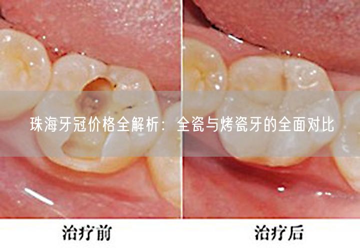 珠海牙冠价格全解析：全瓷与烤瓷牙的全面对比