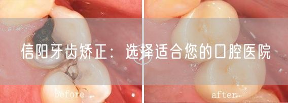 信阳牙齿矫正：选择适合您的口腔医院