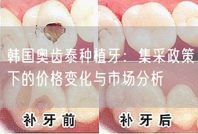 韩国奥齿泰种植牙：集采政策下的价格变化与市场分析