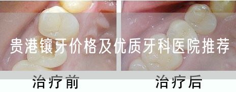 贵港镶牙价格及优质牙科医院推荐