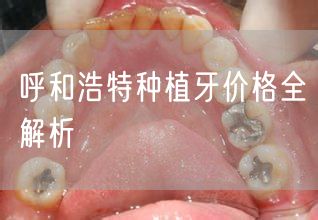 呼和浩特种植牙价格全解析