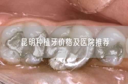 昆明种植牙价格及医院推荐