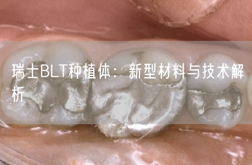瑞士BLT种植体：新型材料与技术解析(图1)