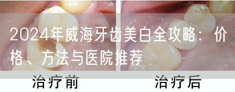 2024年威海牙齿美白全攻略：价格、方法与医院推荐
