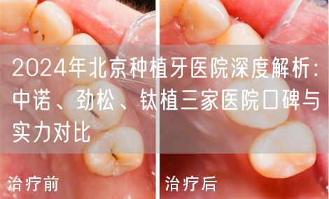2024年北京种植牙医院深度解析：中诺、劲松、钛植三家医院口碑与实力对比