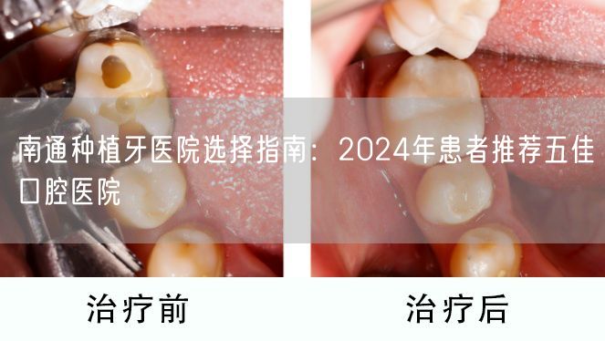 南通种植牙医院选择指南：2024年患者推荐五佳口腔医院