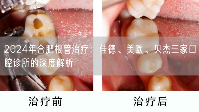 2024年合肥根管治疗：佳德、美欧、贝杰三家口腔诊所的深度解析