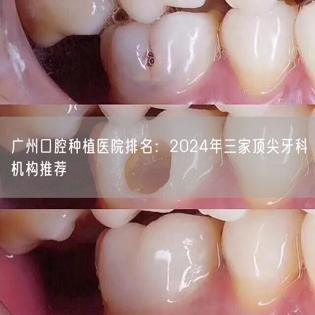 广州口腔种植医院排名：2024年三家顶尖牙科机构推荐