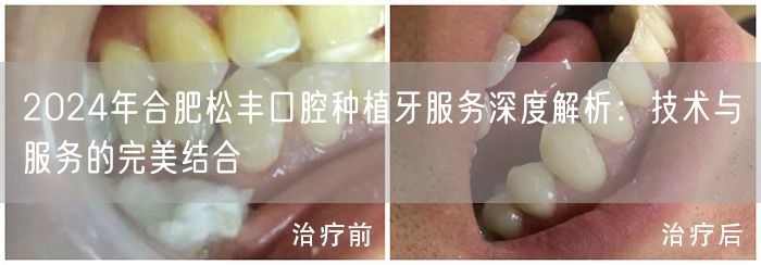 2024年合肥松丰口腔种植牙服务深度解析：技术与服务的完美结合