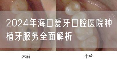 2024年海口爱牙口腔医院种植牙服务全面解析