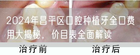 2024年昌平区口腔种植牙全口费用大揭秘，价目表全面解读