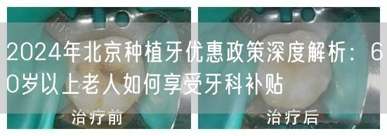 2024年北京种植牙优惠政策深度解析：60岁以上老人如何享受牙科补贴