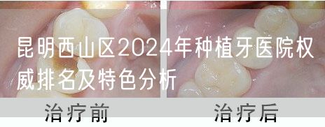 昆明西山区2024年种植牙医院权威排名及特色分析