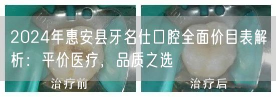 2024年惠安县牙名仕口腔全面价目表解析：平价医疗，品质之选