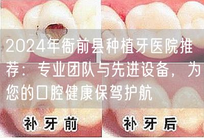 2024年衙前县种植牙医院推荐：专业团队与先进设备，为您的口腔健康保驾护航