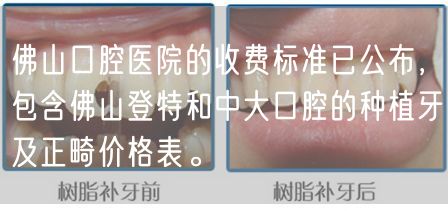 佛山口腔医院的收费标准已公布，包含佛山登特和中大口腔的种植牙及正畸价格表。