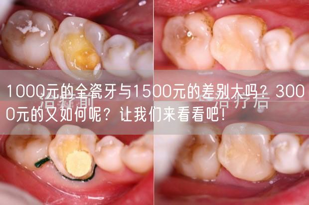 1000元的全瓷牙与1500元的差别大吗？3000元的又如何呢？让我们来看看吧！