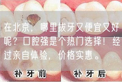在北京，哪里拔牙又便宜又好呢？口腔强是个热门选择！经过亲自体验，价格实惠。