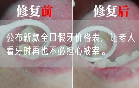 公布新款全口假牙价格表，让老人看牙时再也不必担心被宰。