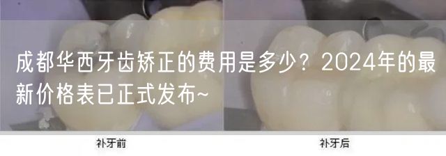 成都华西牙齿矫正的费用是多少？2024年的最新价格表已正式发布~