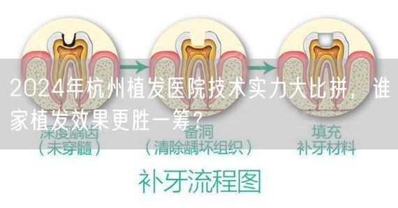 2024年杭州植发医院技术实力大比拼，谁家植发效果更胜一筹？