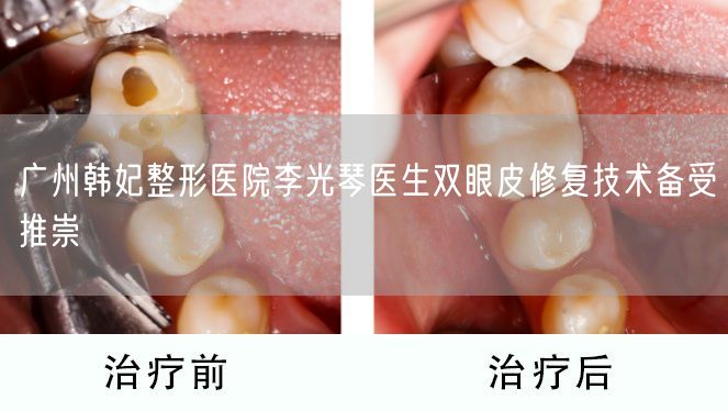 广州韩妃整形医院李光琴医生双眼皮修复技术备受推崇