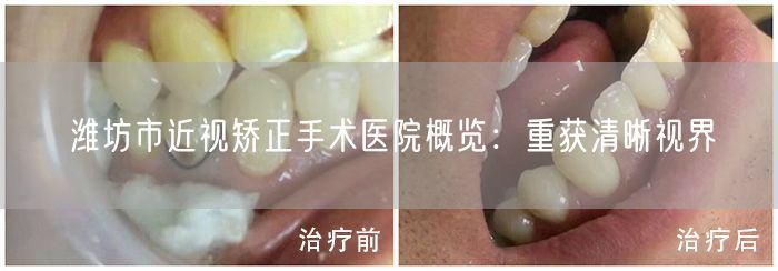 潍坊市近视矫正手术医院概览：重获清晰视界