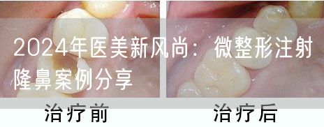 2024年医美新风尚：微整形注射隆鼻案例分享