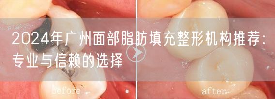 2024年广州面部脂肪填充整形机构推荐：专业与信赖的选择