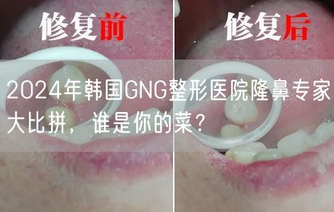 2024年韩国GNG整形医院隆鼻专家大比拼，谁是你的菜？