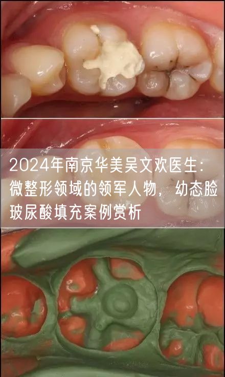 2024年南京华美吴文欢医生：微整形领域的领军人物，幼态脸玻尿酸填充案例赏析