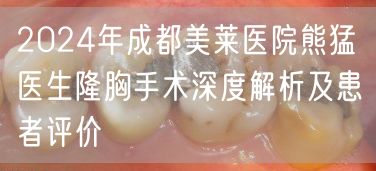 2024年成都美莱医院熊猛医生隆胸手术深度解析及患者评价