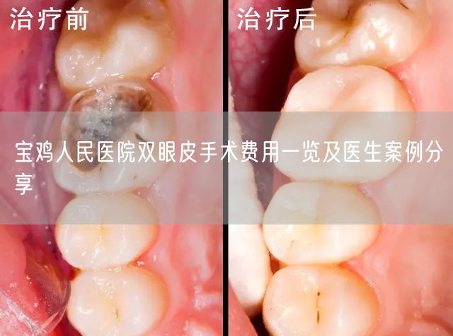 宝鸡人民医院双眼皮手术费用一览及医生案例分享