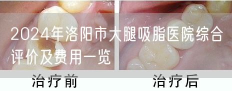 2024年洛阳市大腿吸脂医院综合评价及费用一览
