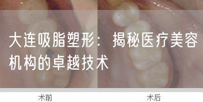 大连吸脂塑形：揭秘医疗美容机构的卓越技术