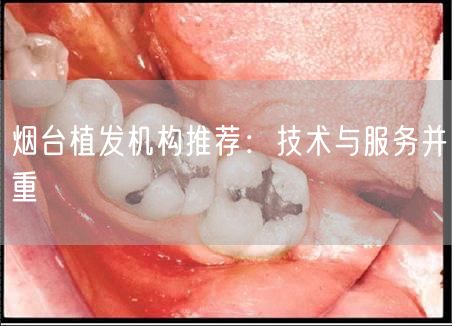 烟台植发机构推荐：技术与服务并重