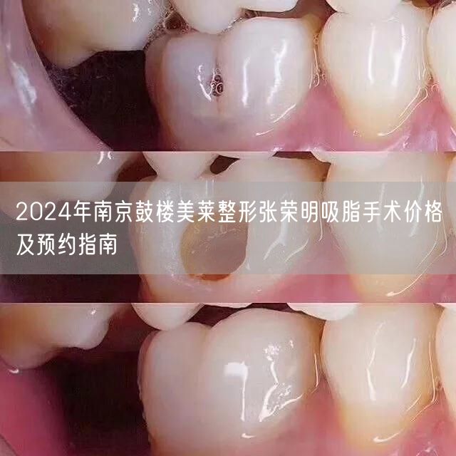 2024年南京鼓楼美莱整形张荣明吸脂手术价格及预约指南