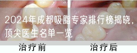 2024年成都吸脂专家排行榜揭晓，顶尖医生名单一览
