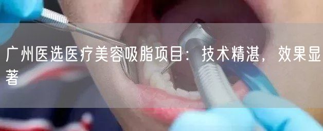 广州医选医疗美容吸脂项目：技术精湛，效果显著