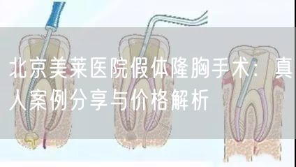 北京美莱医院假体隆胸手术：真人案例分享与价格解析