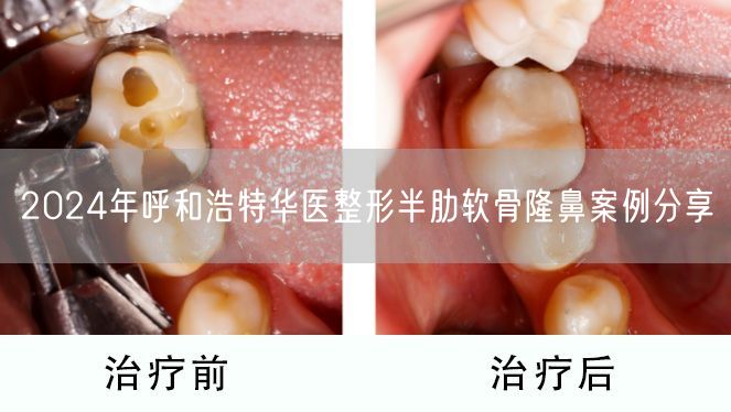 2024年呼和浩特华医整形半肋软骨隆鼻案例分享