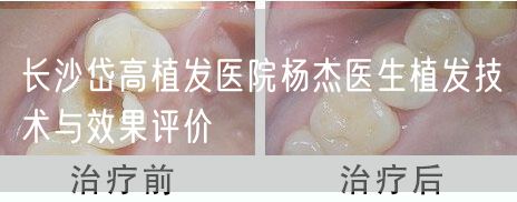 长沙岱高植发医院杨杰医生植发技术与效果评价