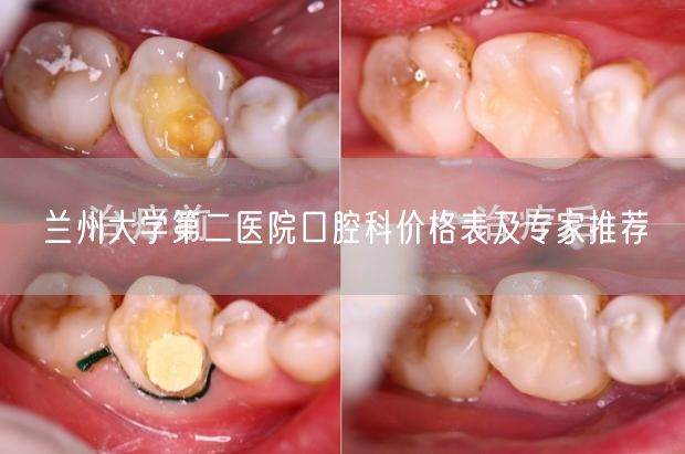 兰州大学第二医院口腔科价格表及专家推荐